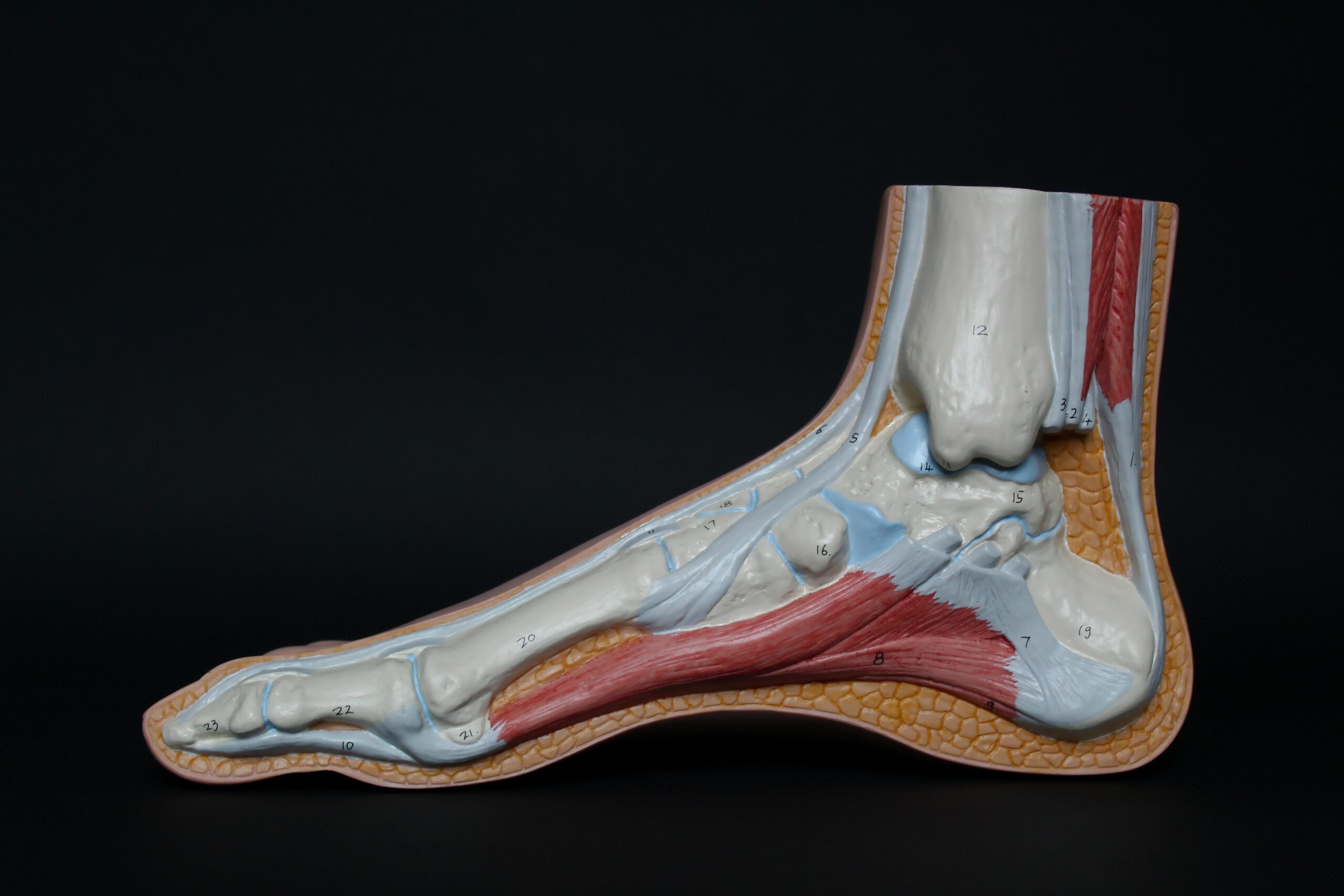 X-ray of a feet (Osteoarthritis)