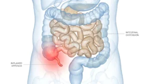 Can Appendicitis Cause Abdominal Distension
