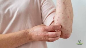 How Serious Is a Dengue Fever Rash