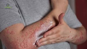 How Serious Is a Dengue Fever Rash